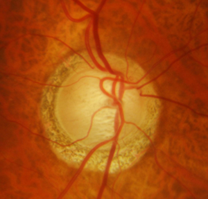 Fig. 1 - Papilla ottica glaucomatosa