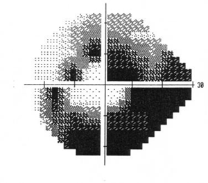 Fig. 2 – Campo visivo glaucomatoso