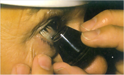 Fig. 4 – Applicazione della lente gonioscopica all’occhio 